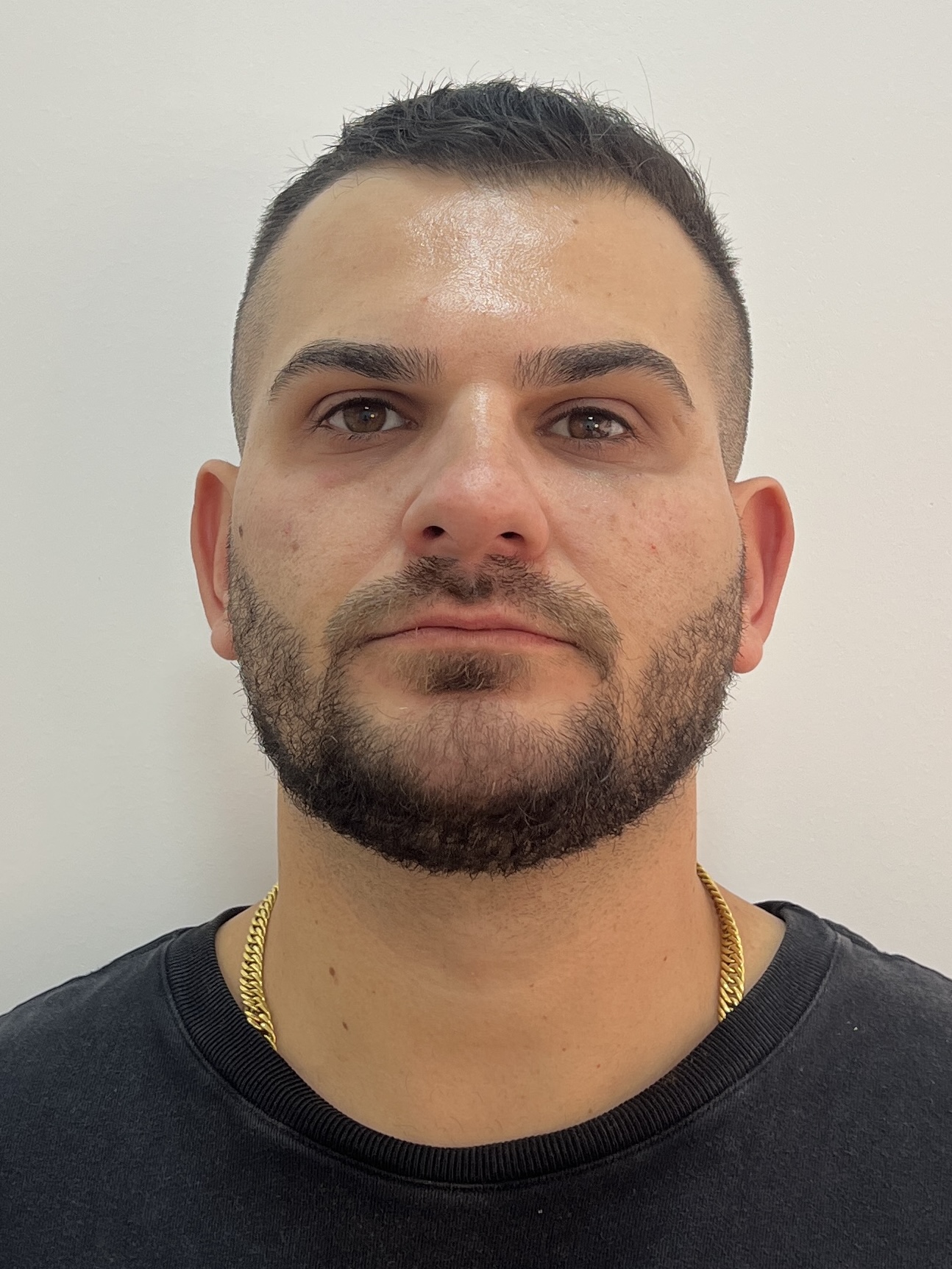 Zéfo depois da harmonização facial - com barba